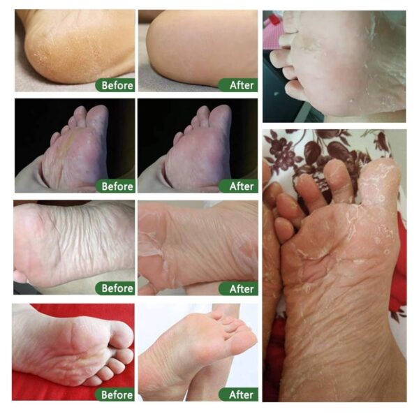 Mascarilla exfoliante para pies - Imagen 3